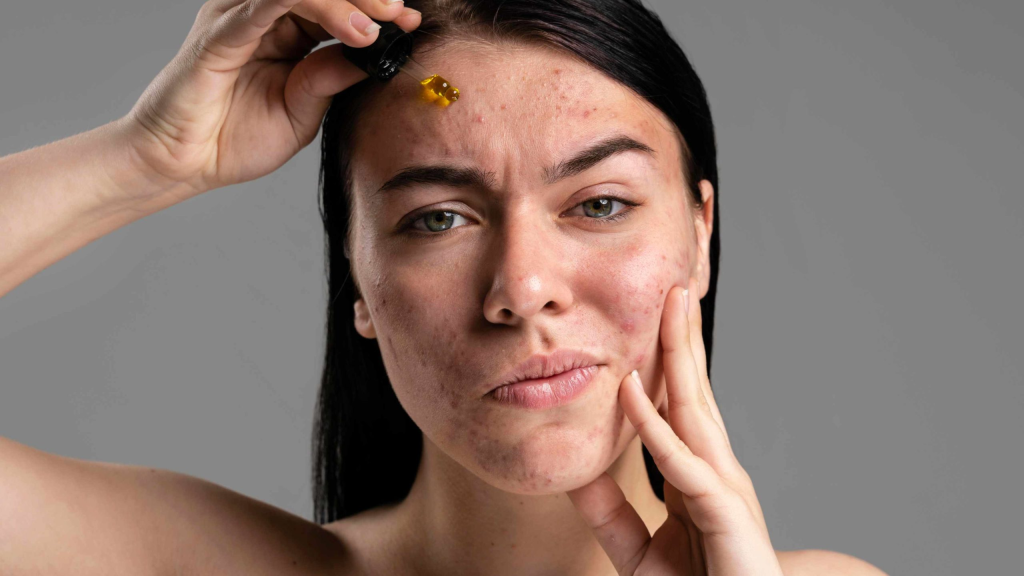 Como tratar e prevenir acne com produtos naturais